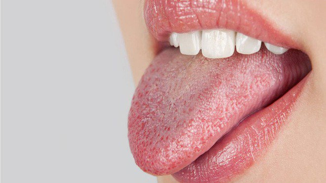 Khô miệng: Nguyên nhân, triệu chứng và điều trị