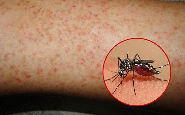 Phân biệt sốt xuất huyết với sốt thông thường để sớm phát hiện bệnh