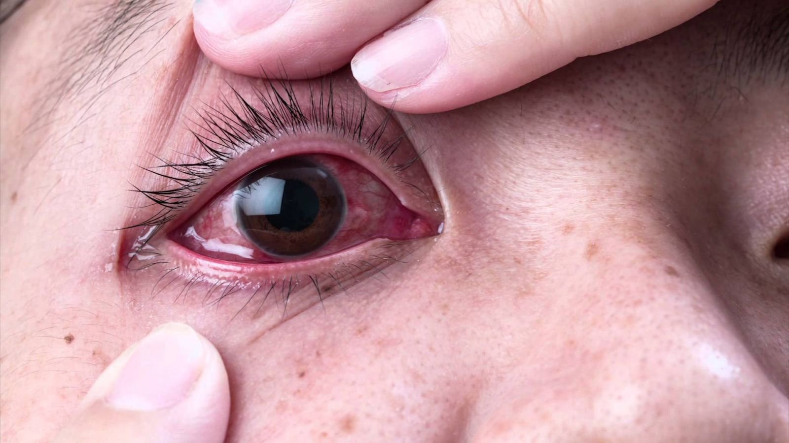 Bệnh viêm kết mạc do virus (đau mắt đỏ) dễ lây mạnh, cảnh giác trong mùa xuân hè