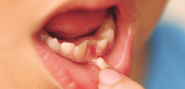 Trẻ thay răng sữa: Có nên tự nhổ cho trẻ?
