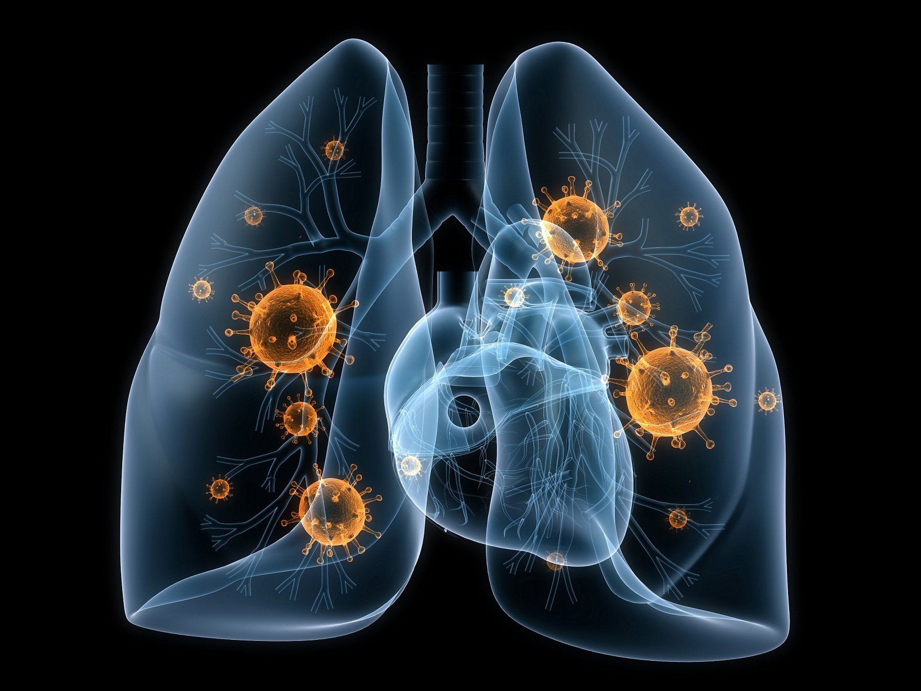 Chẩn đoán và điều trị viêm phổi cộng đồng