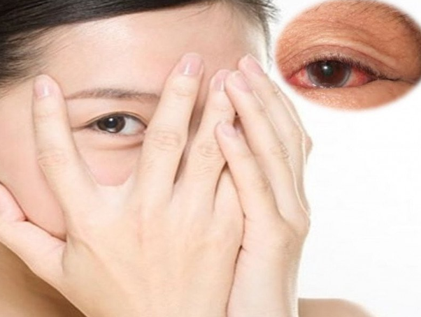 Đau mắt đỏ cần kiêng gì? Những điều cần lưu ý