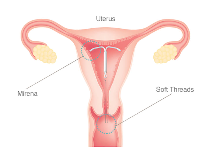 Vòng tránh thai nội tiết là gì?
