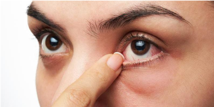 Bệnh mắt hột: Nguyên nhân, triệu chứng và cách điều trị