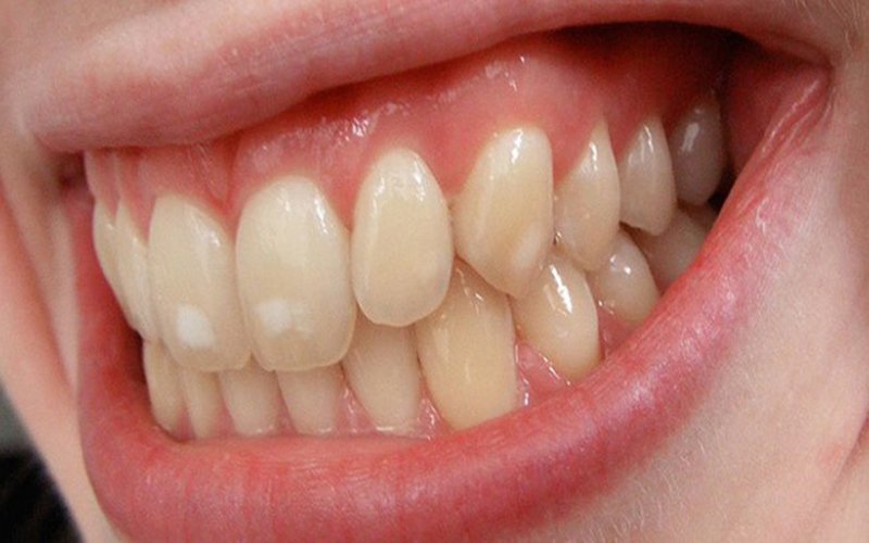 Răng nhiễm Tetracycline là gì? Nguyên nhân và cách khắc phục