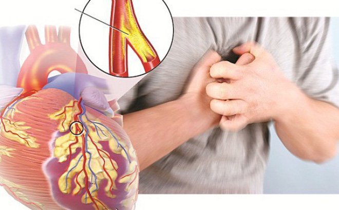 Chụp cắt lớp vi tính tính điểm vôi hóa động mạch vành tim
