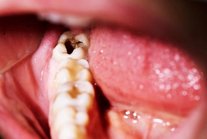 Ngừa sâu răng với thuốc bôi bề mặt răng
