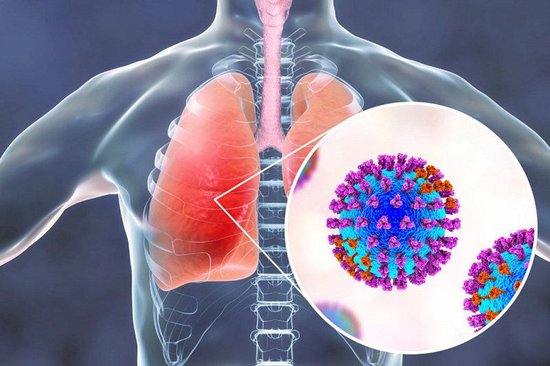 Các loại viêm phổi thường gặp