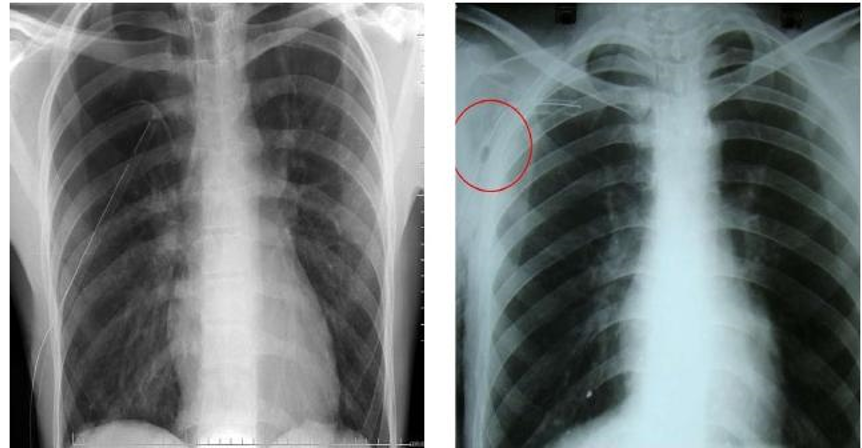 Hình ảnh Chụp X-quang viêm phổi phát hiện ra những bệnh lý nào