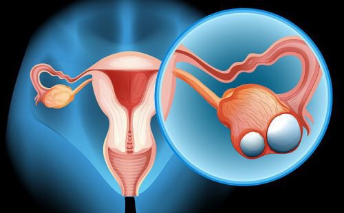 Mổ nội soi – giải pháp tốt cho người bệnh ung thư buồng trứng giai đoạn sớm