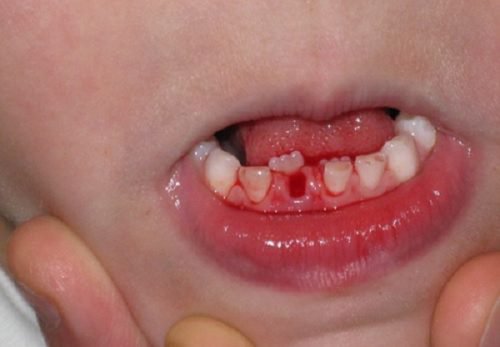 Trẻ bị gãy răng nhưng vẫn còn chân ăn vào nướu có sao không?