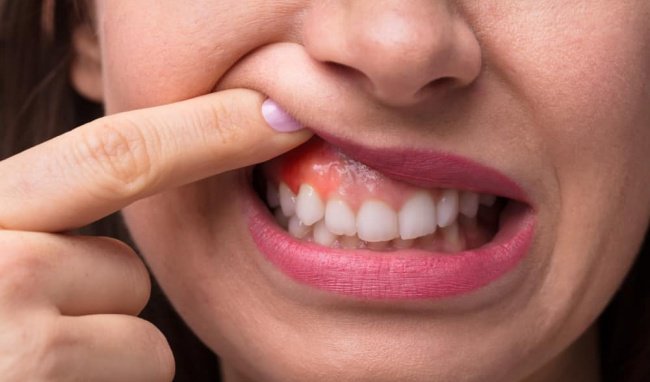 Viêm lợi ở chân răng nên điều trị như thế nào?