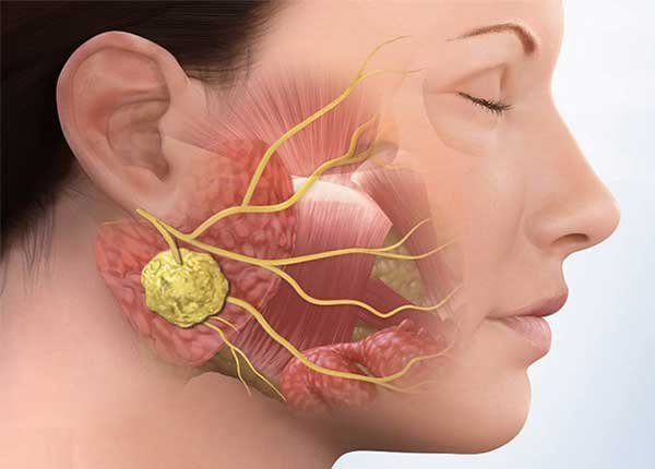 Viêm tuyến nước bọt mang tai có triệu chứng gì?