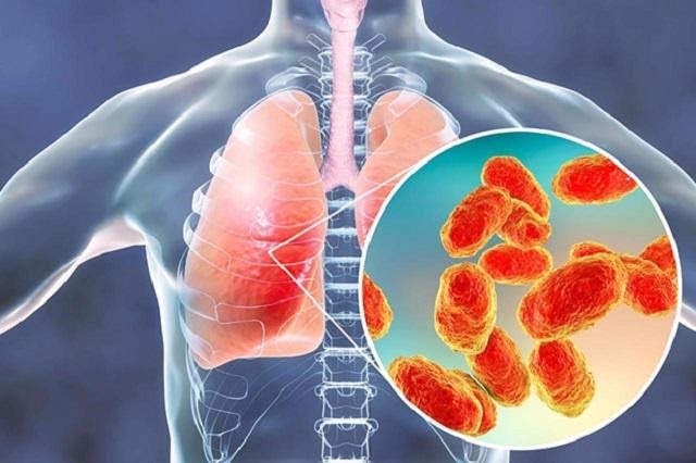 Chẩn đoán viêm phổi như thế nào là chính xác?