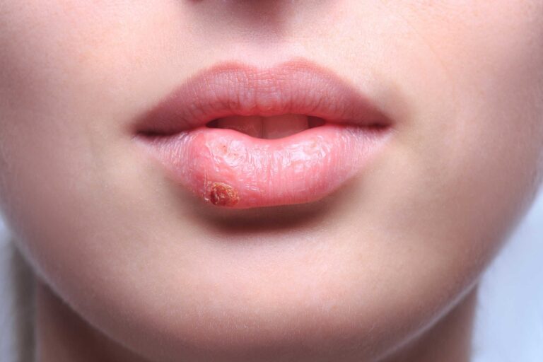 Bị nổi bọng máu ở vành môi có nguy hiểm không?