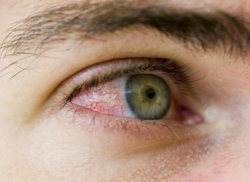 Bệnh viêm kết mạc mắt: Nguyên nhân, triệu chứng, cách điều trị và phòng tránh
