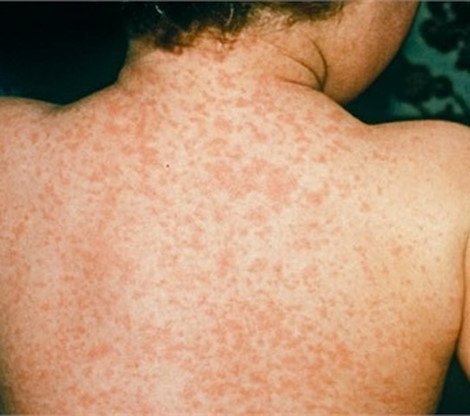 Bệnh rubella: Nguyên nhân, triệu chứng, biến chứng và cách đề phòng