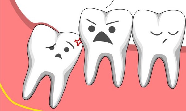 Răng khôn mọc lệch có nên nhổ hay không?