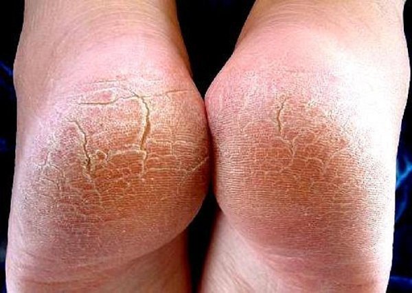Nứt gót chân gây ngứa kèm chảy máu là bệnh gì?