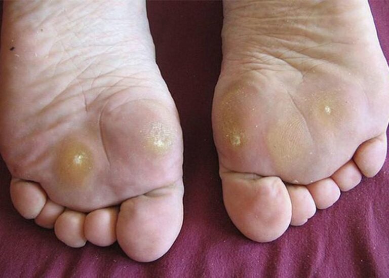 Phương pháp điều trị dứt điểm nấm ở mu bàn chân?