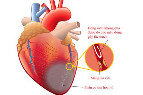 Phục hồi chức năng tim mạch cho người bệnh sau nhồi máu cơ tim