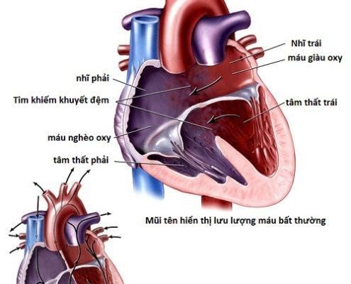 Các biện pháp chẩn đoán bệnh tim bẩm sinh kênh nhĩ thất
