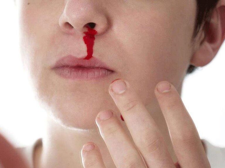 Ho có đờm kèm chảy máu mũi cảnh báo bệnh gì?