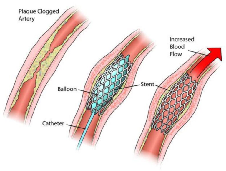 Đặt stent mạch vành và những điều bạn cần lưu ý