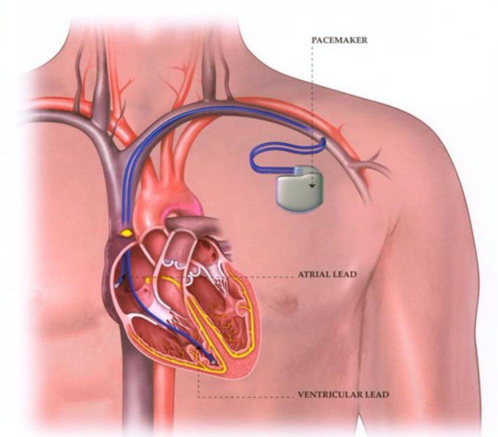Vai trò của máy tạo nhịp tim