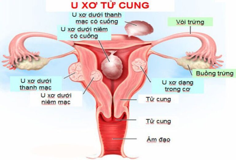 U xơ cổ tử cung kích thước 30×32 chặn lối tinh trùng có cách nào mang thai không?