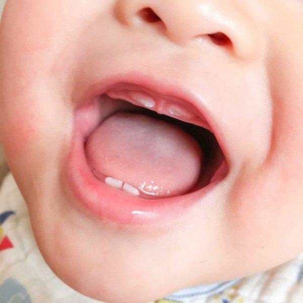 Trẻ có dấu hiệu mọc răng bất thường có sao không?