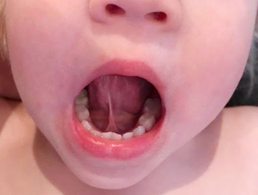 Vinmec có điều trị viêm amidan cấp kèm dính thắng lưỡi cho trẻ không?
