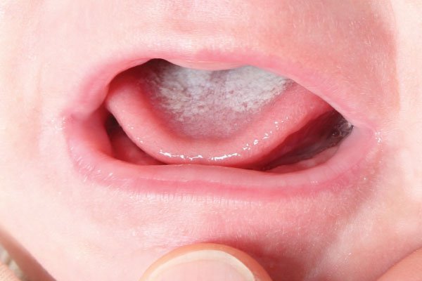 Trẻ 9 tháng tuổi biếng ăn kèm lưỡi bé bị trắng có sao không?