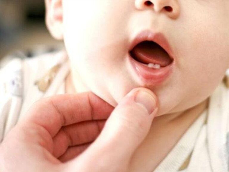 Trẻ 19 tháng tuổi mọc 5 chiếc răng có nên đi khám không?