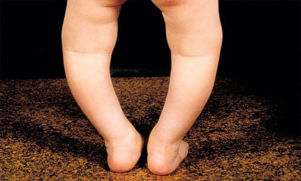 Trẻ 1 tuổi bị chân vòng kiềng có cần điều trị không?