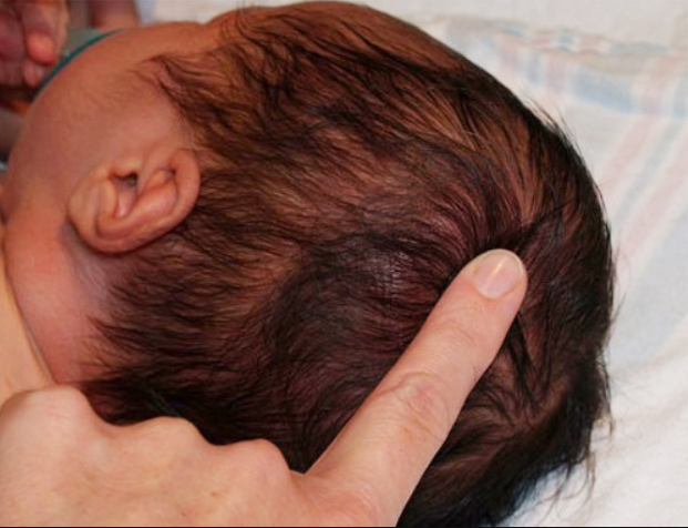 Sau 2 tuần trẻ tiêm vắc-xin bạch hầu nổi cục tròn vùng đầu có sao không?