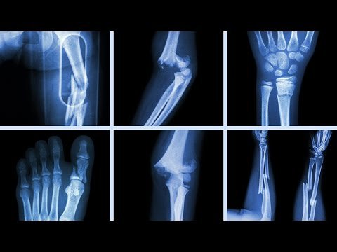 Gãy xương: Trường hợp nào cần mổ?