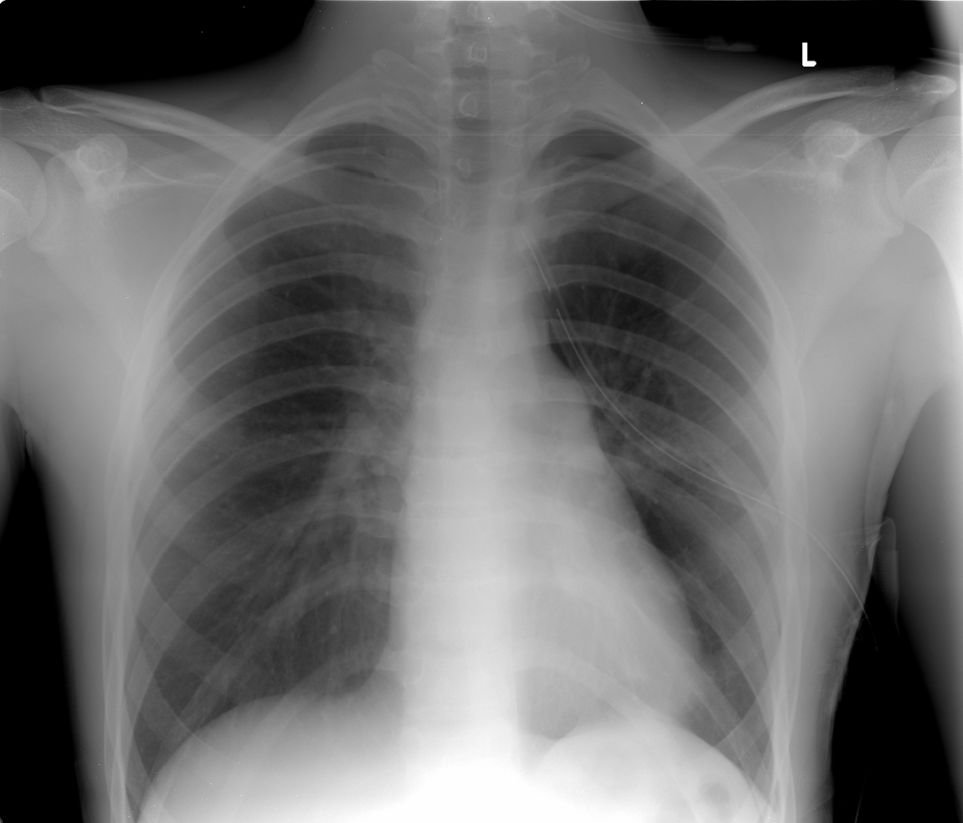 Tràn dịch màng phổi ở người tiểu đường đã hút dịch thì bao lâu có thể chụp CT lại?