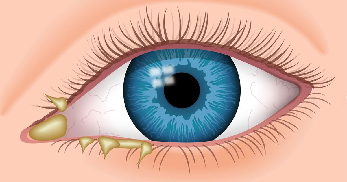 Mắt bị ghèn mắt kéo dài kèm khô mắt là dấu hiệu bệnh gì?