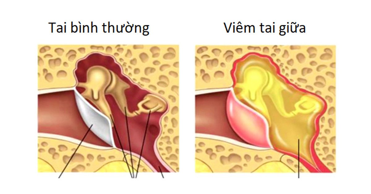 Vì sao bị viêm tai giữa dẫn đến thủng màng nhĩ có chảy dịch tai?