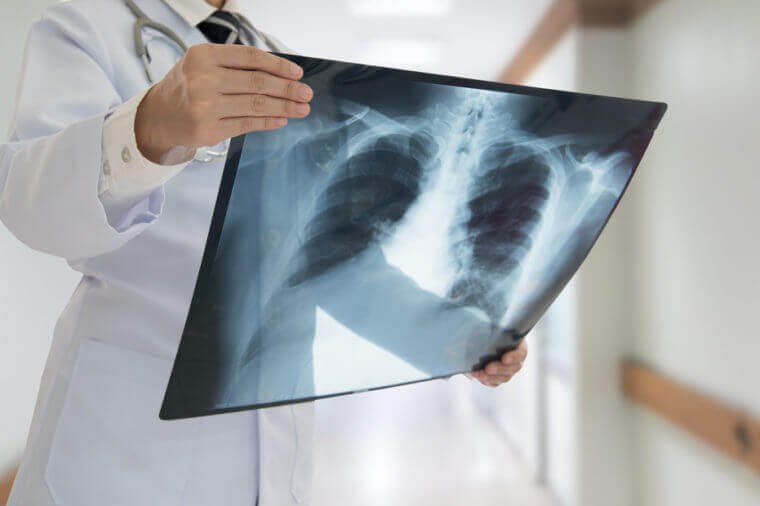 Kết quả chụp X quang phổi thâm nhiễm phế trường có xơ hóa nghĩa là gì?