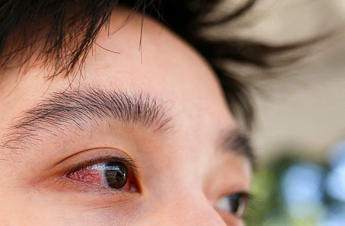 Viêm kết mạc mắt điều trị không khỏi phải làm sao?