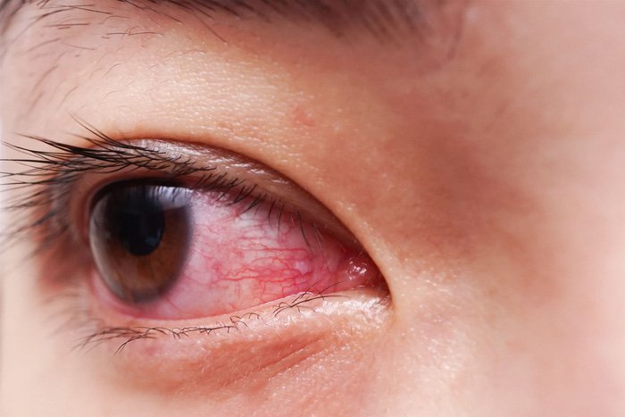 Mắt nổi tia máu kèm hạt nước là dấu hiệu bệnh gì?
