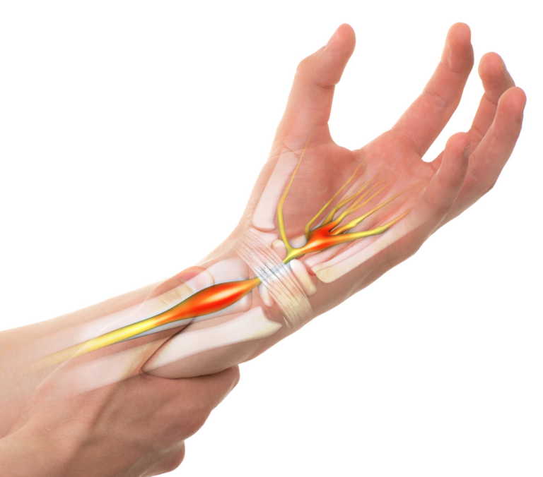 Mổ điều trị hội chứng ống cổ tay: Những điều cần biết