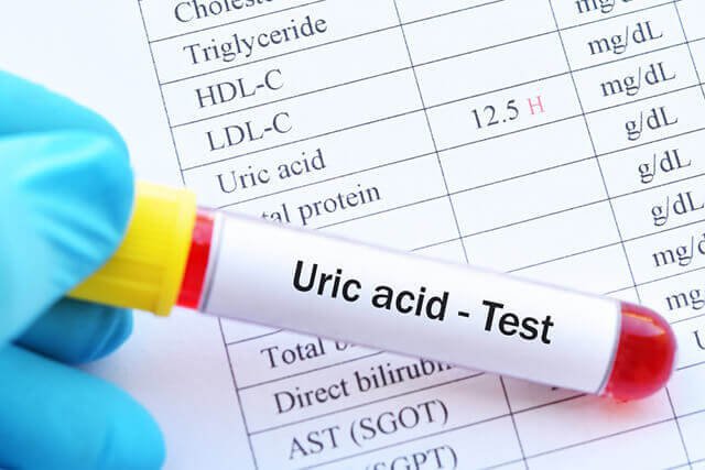 Nồng độ acid uric trong máu cao bao nhiêu là bị gout?