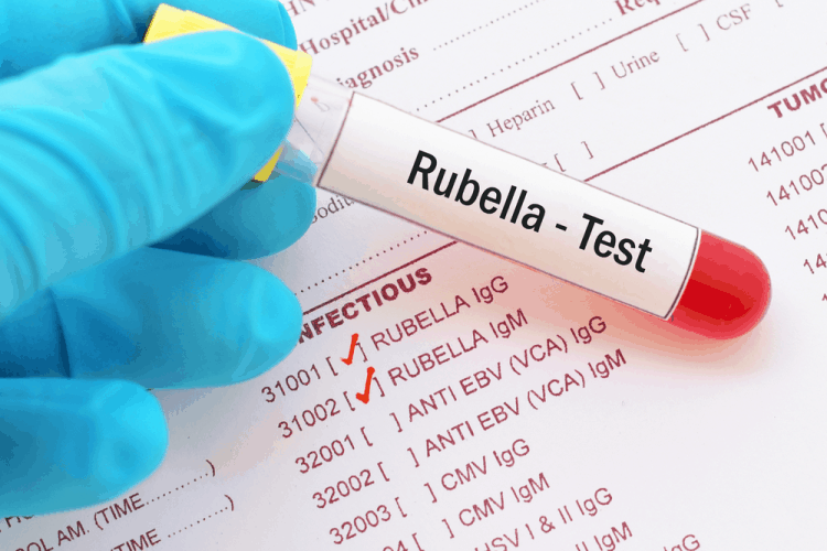 Kết quả xét nghiệm Rubella IgM âm tính và IgG dương tính là gì?