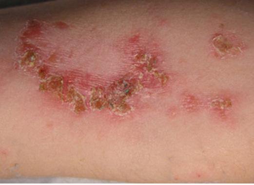 Các bệnh ngoài da thường gặp ở trẻ nhỏ