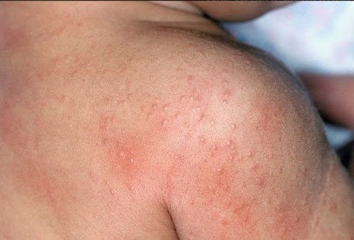 Các bệnh ngoài da thường gặp ở trẻ nhỏ