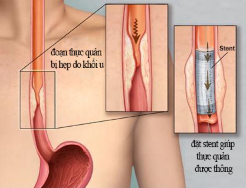 Kỹ thuật nội soi can thiệp đặt stent thực quản