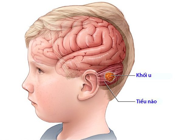 Chụp MRI trẻ em